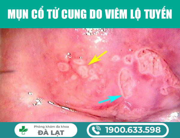 Hình ảnh minh họa